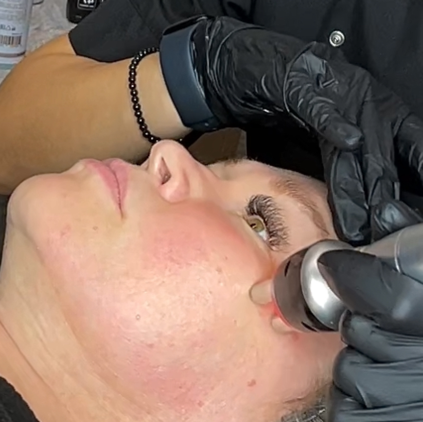 RF-лифтинг лица