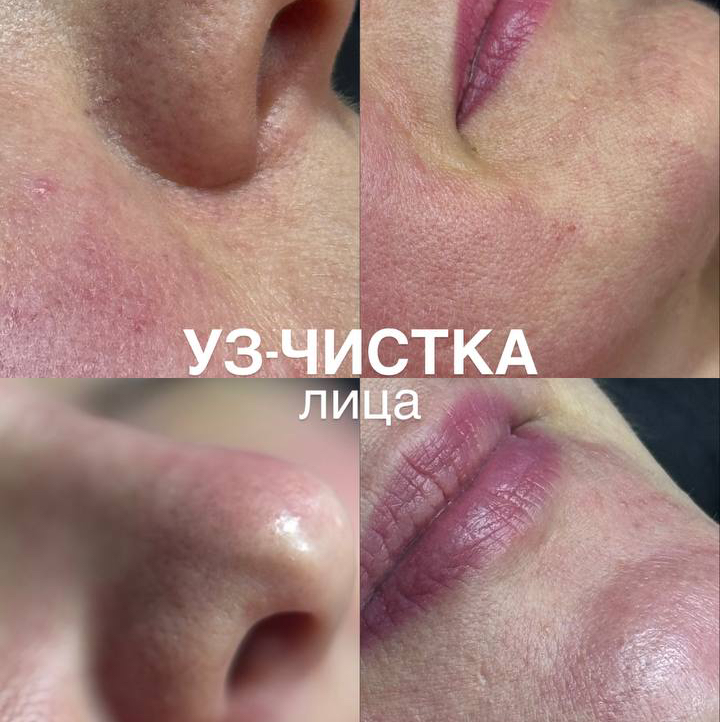 Ультразвуковая чистка лица