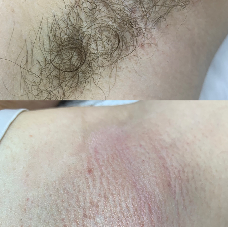 Комплекс 1 (глубокое бикини+подмышки)