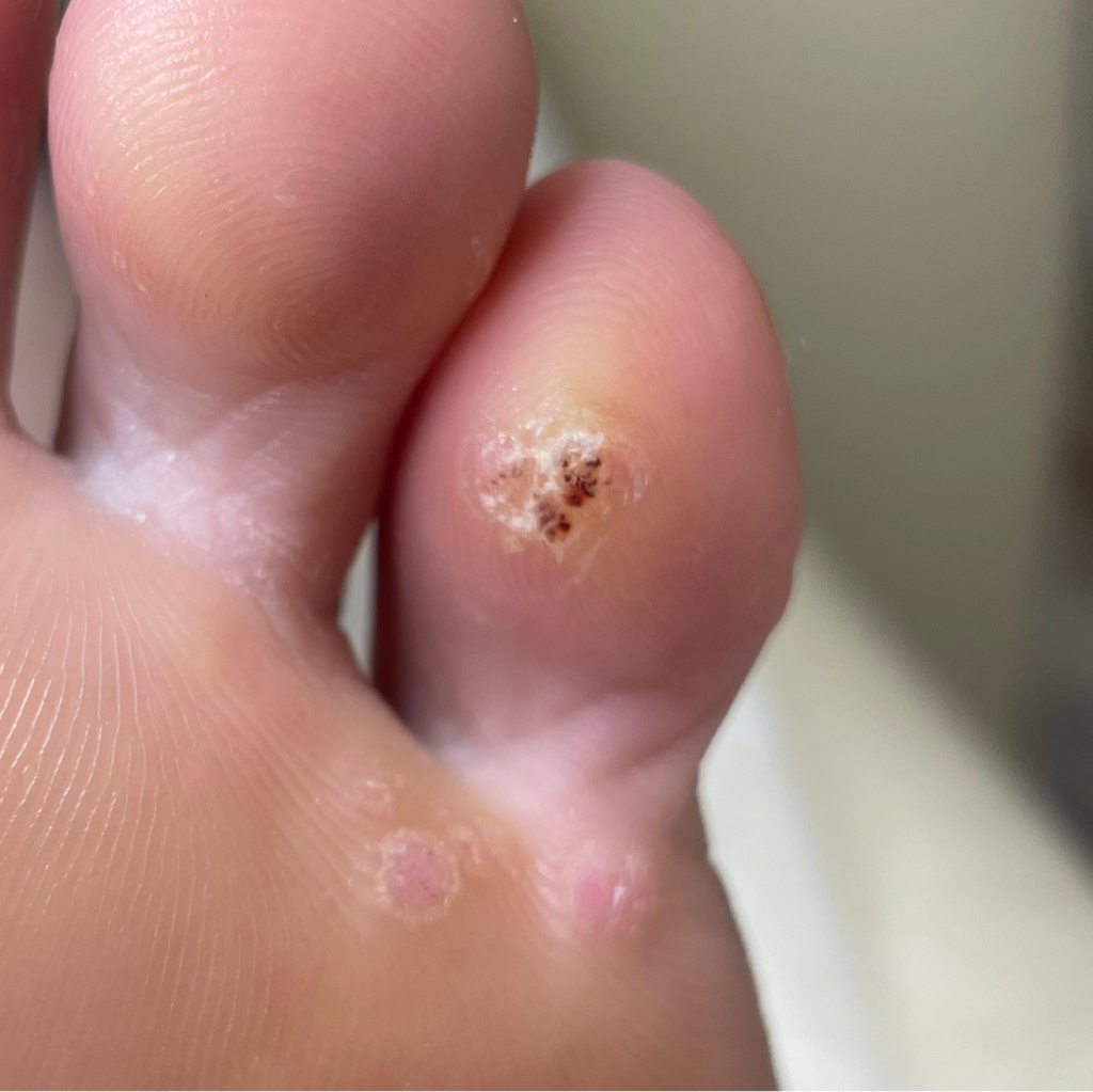 Обработка бородавки