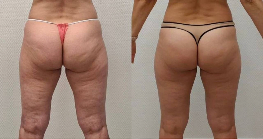 КОМПЛЕКС «ПРОЩАЙ ЦЕЛЛЮЛИТ»