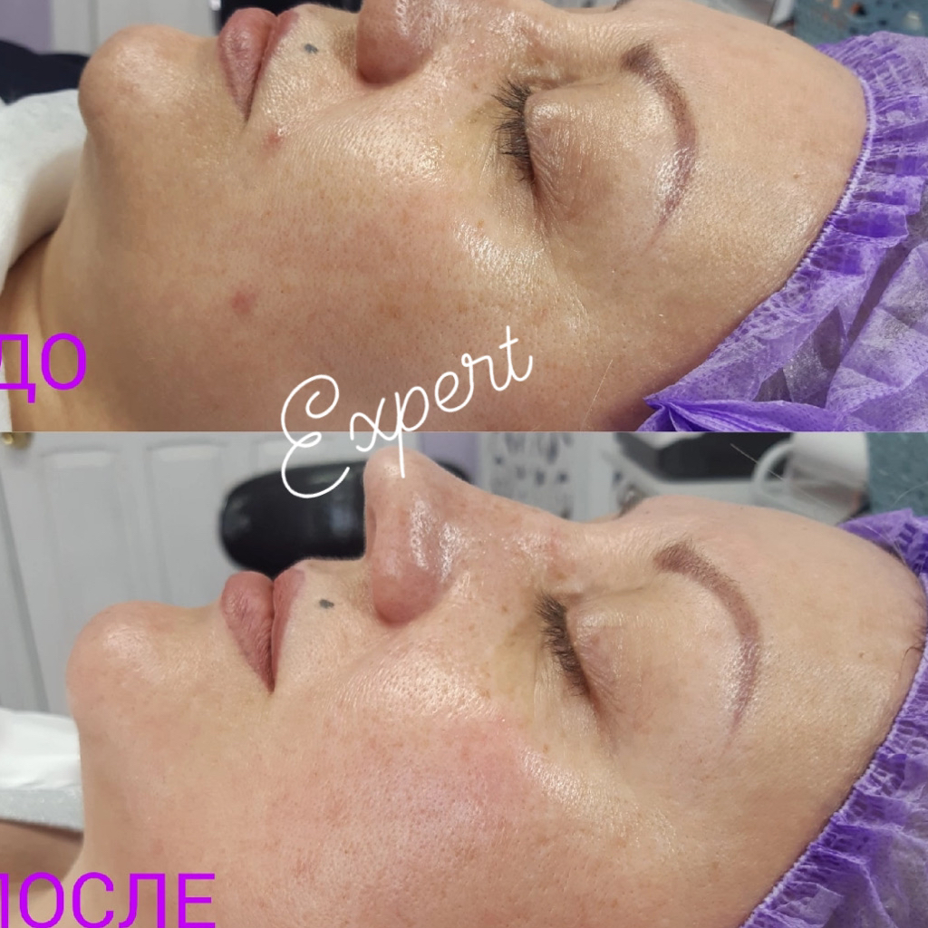 Пилинг prx-t33