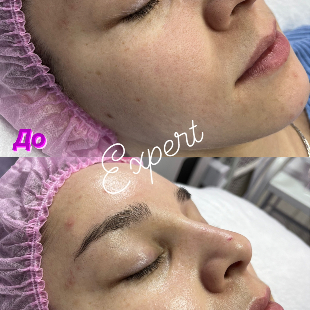 Ультразвуковая чистка лица