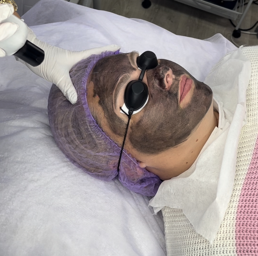 Карбоновый пилинг