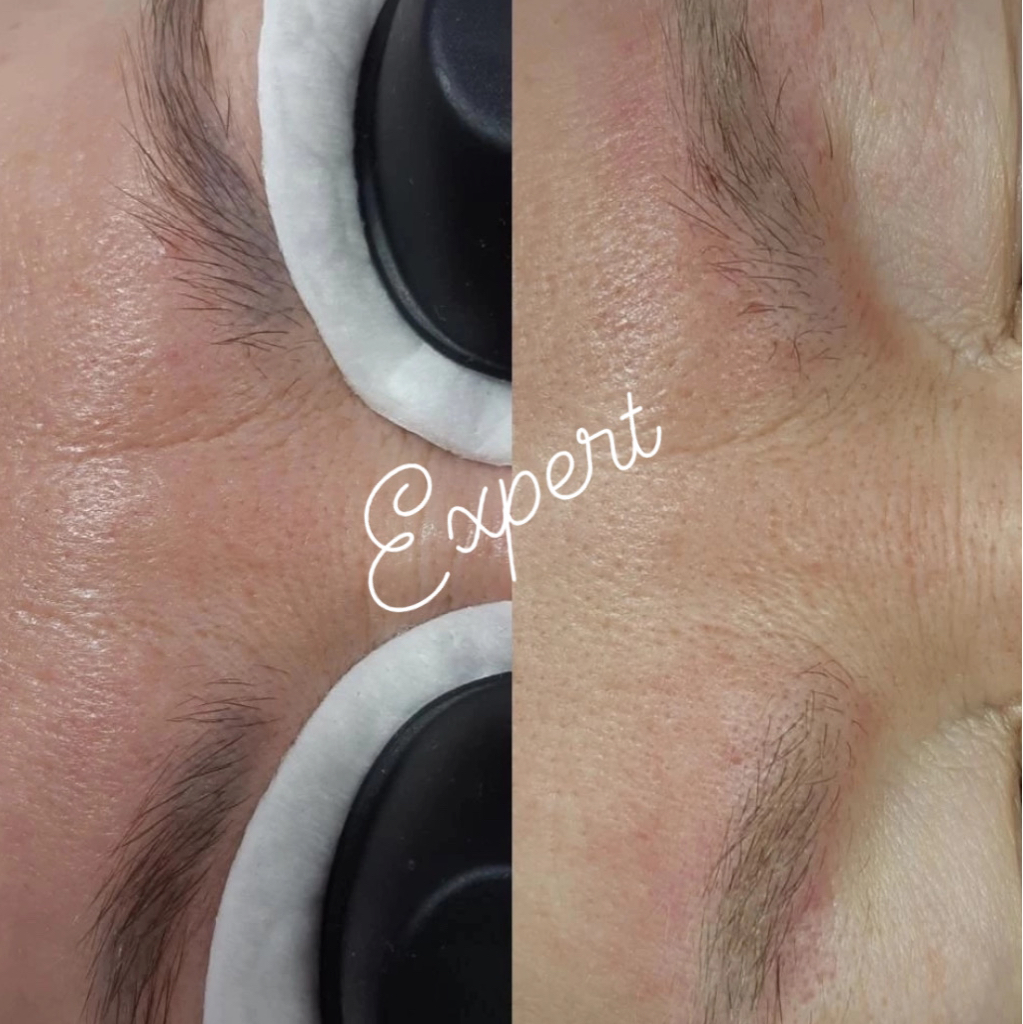 Удаление бровей