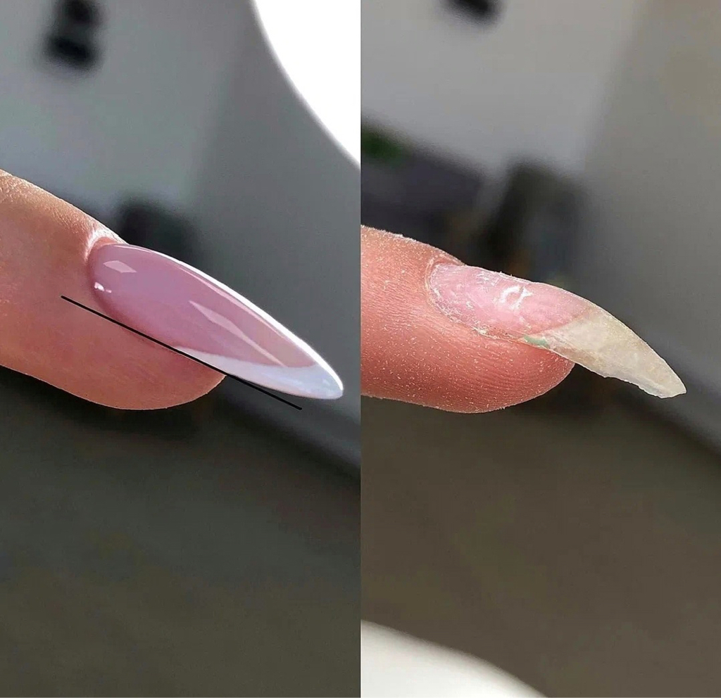 Поднятие клюющих ногтей