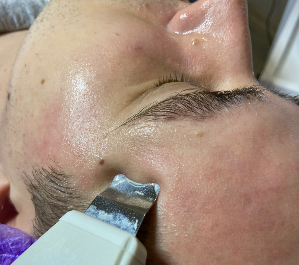 Ультразвуковая чистка лица