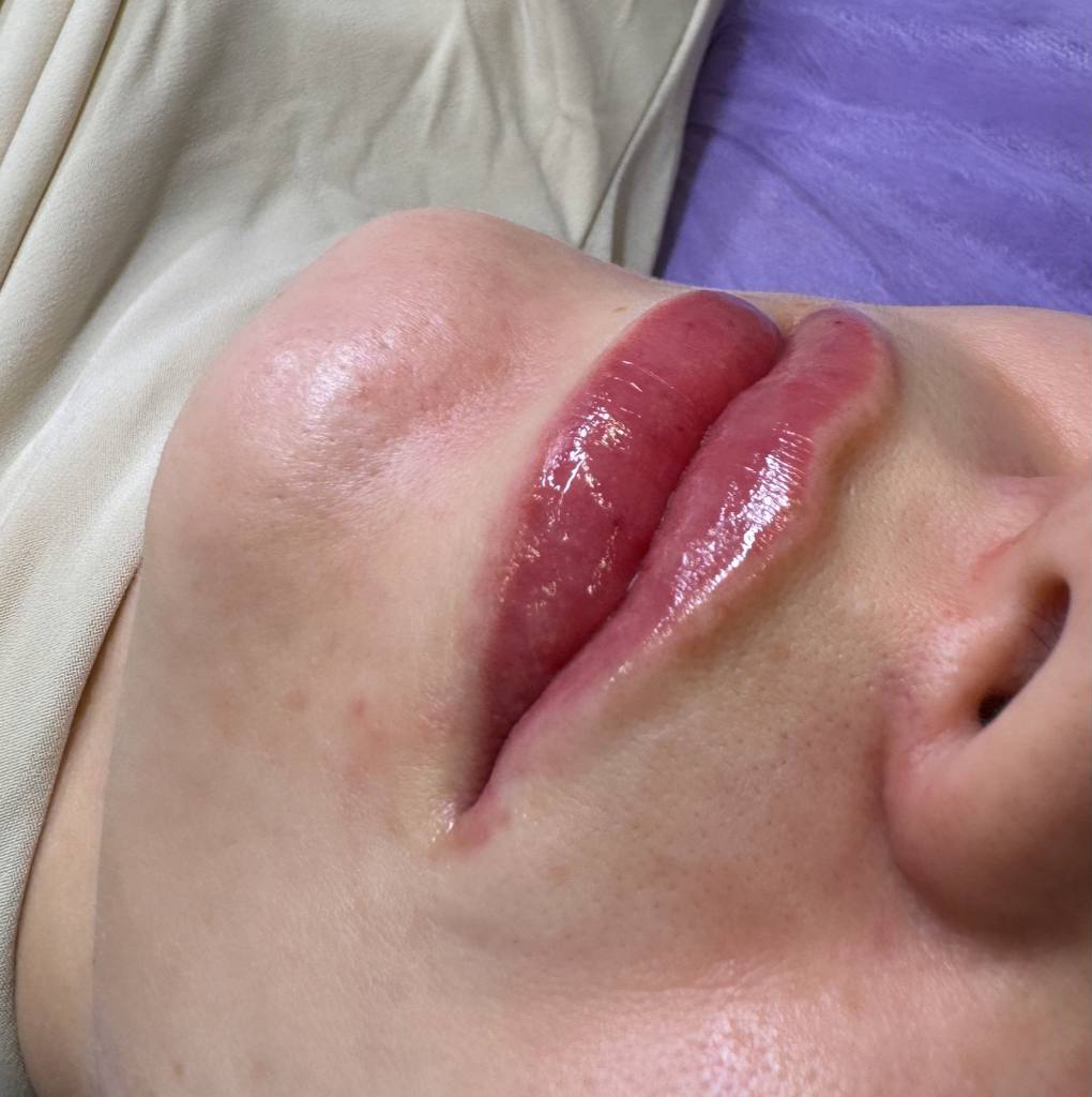 Биоревитализация губ