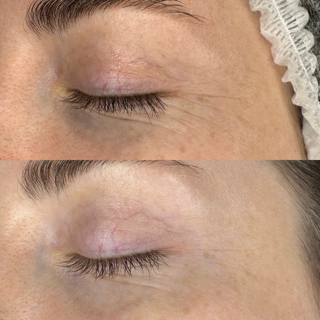 Увлажнение и укрепление зоны вокруг глаз