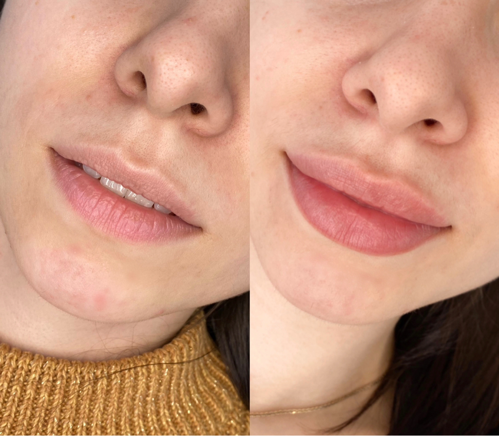 Увлажняющая процедура для губ