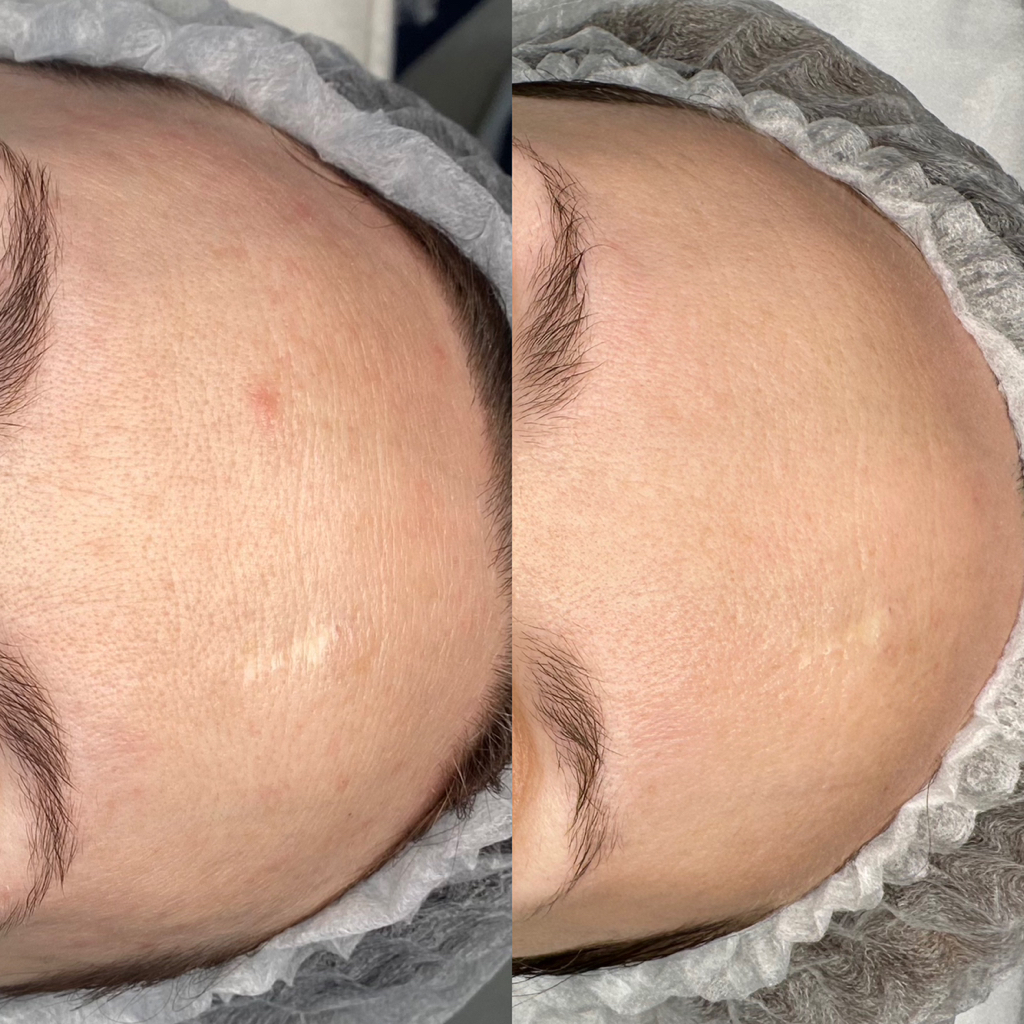 Микронидлинг