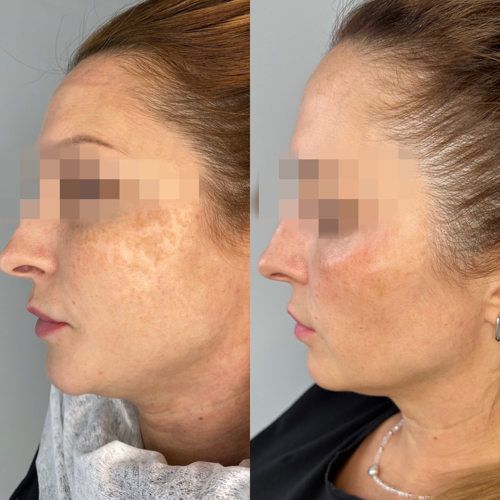 TARGET SISTEM программа от пигментации MediDerma