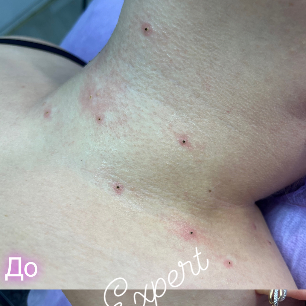 Удаление папиллом