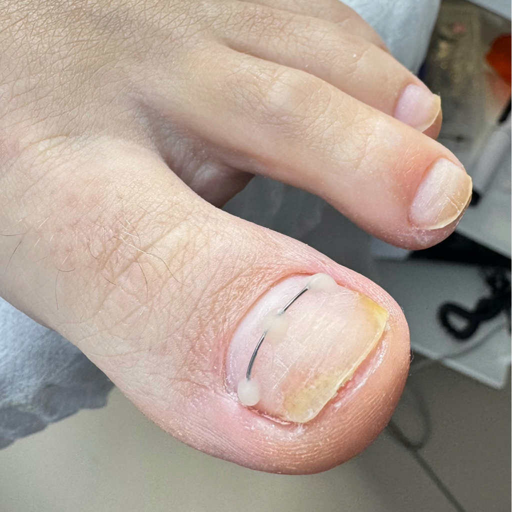 Титановая нить за ед.