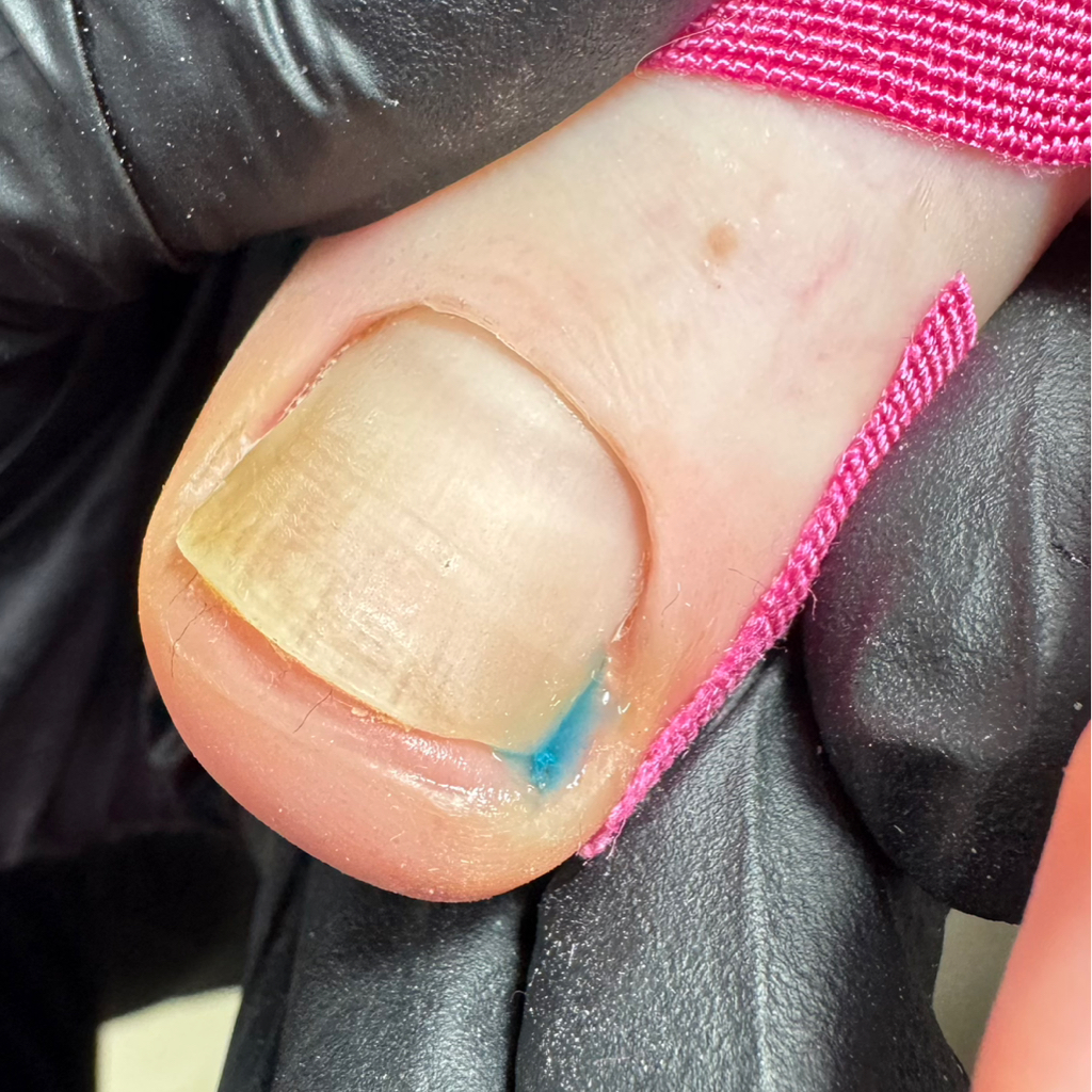 Тампонада за ед.