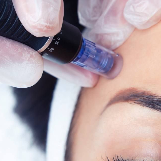 Фракционная мезотерапия(микронидлинг)