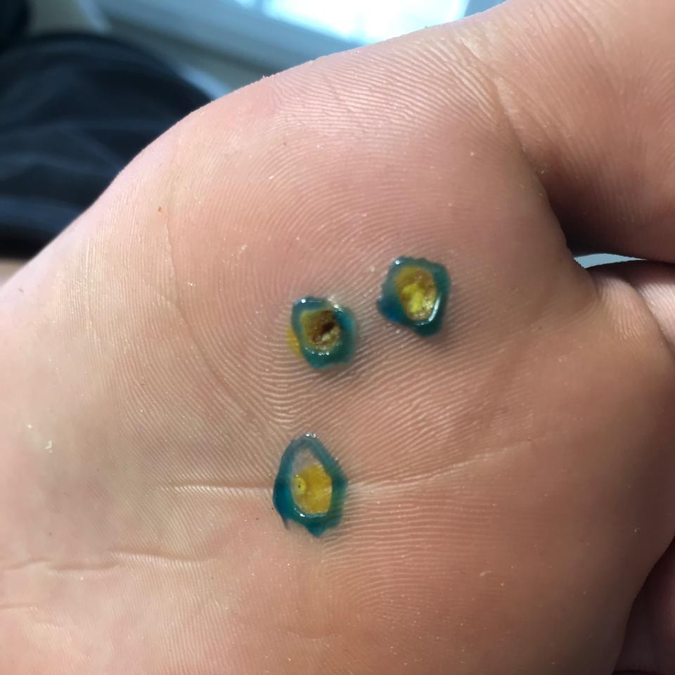 Удаление бородавки