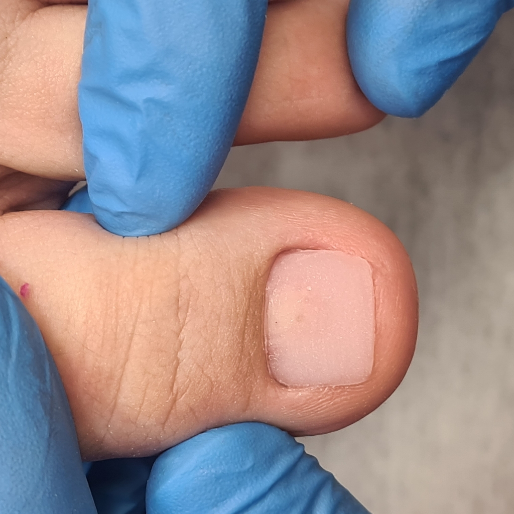 Протезирование ногтевой пластины