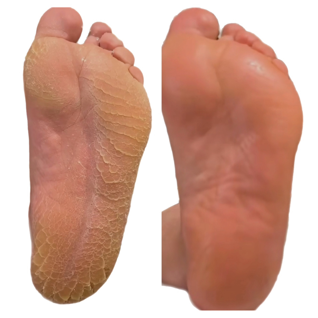 Педикюр сложные стопы