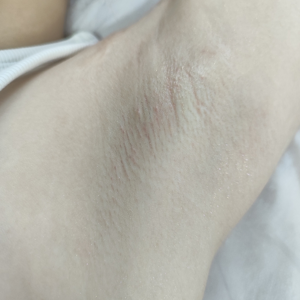 Депиляция подмышечные впадины