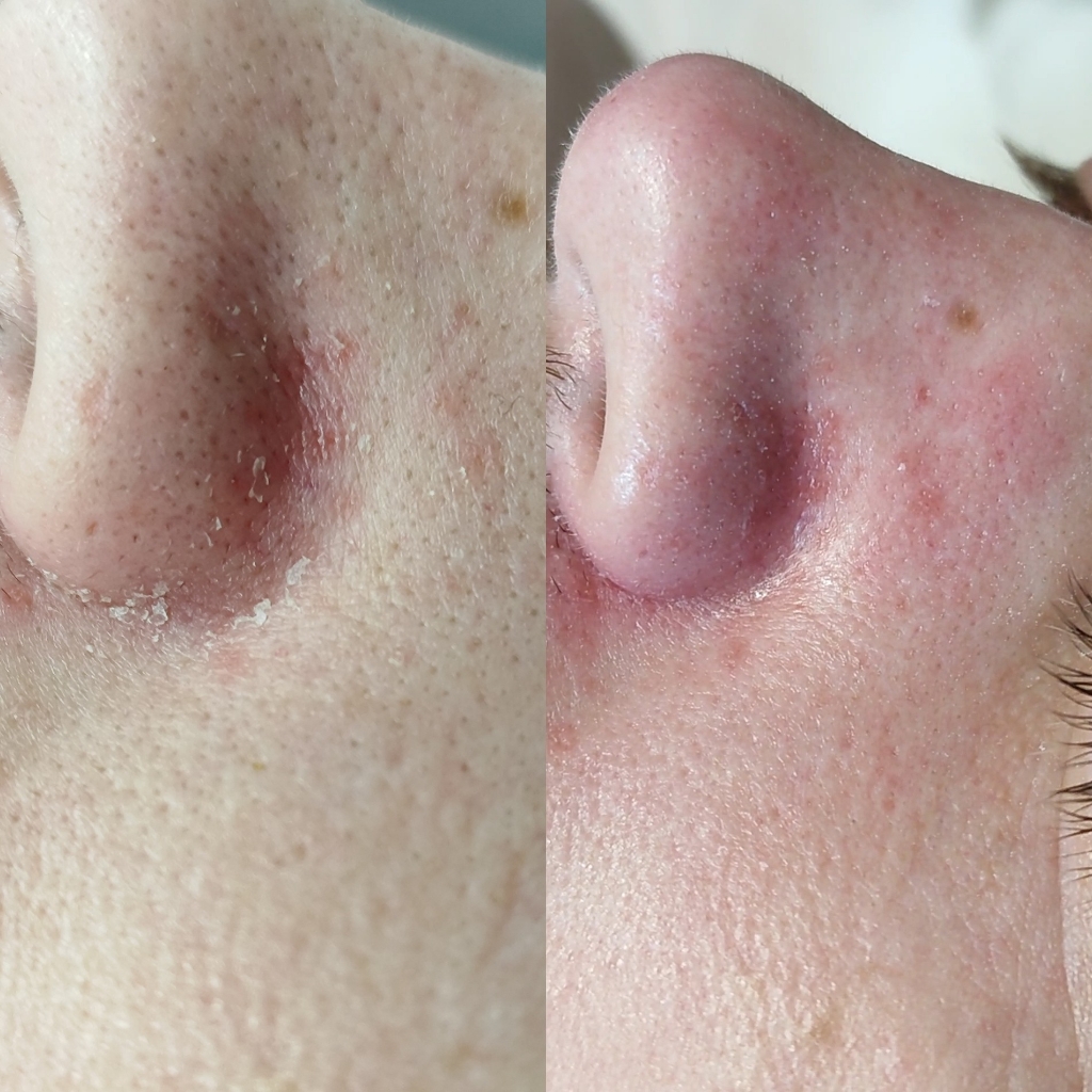 Чистка лица +пилинг Dbright