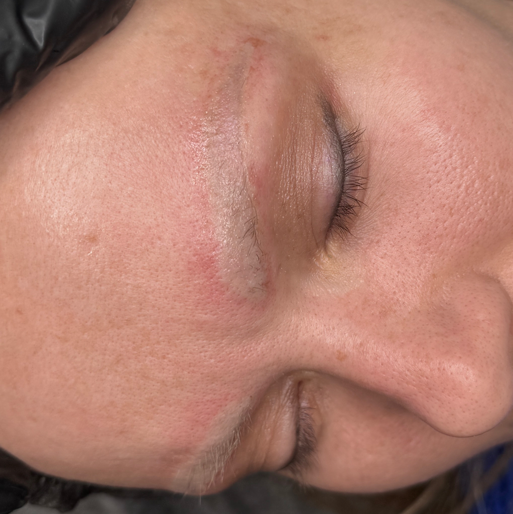 Осветление татуажа ремувером (1 зона)