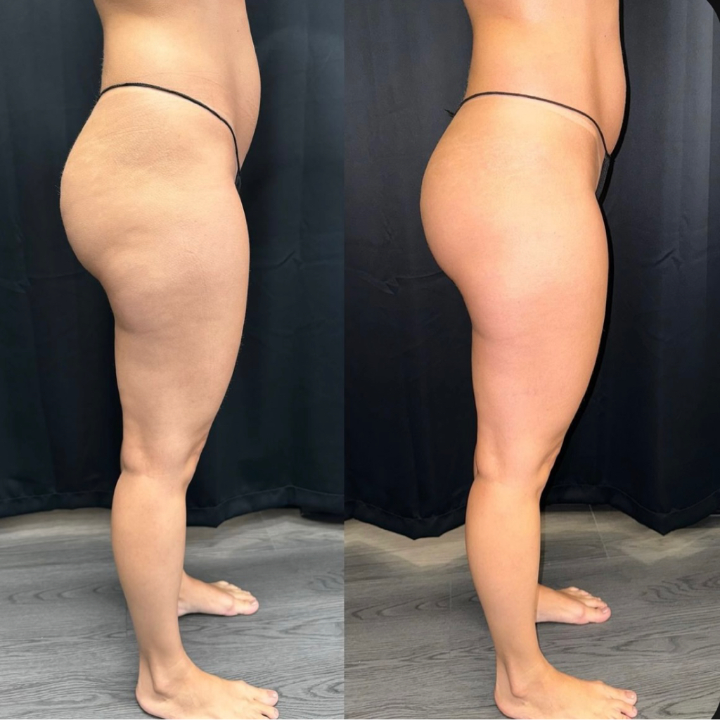 Микроигольчатый рф лифтинг зона ягодиц