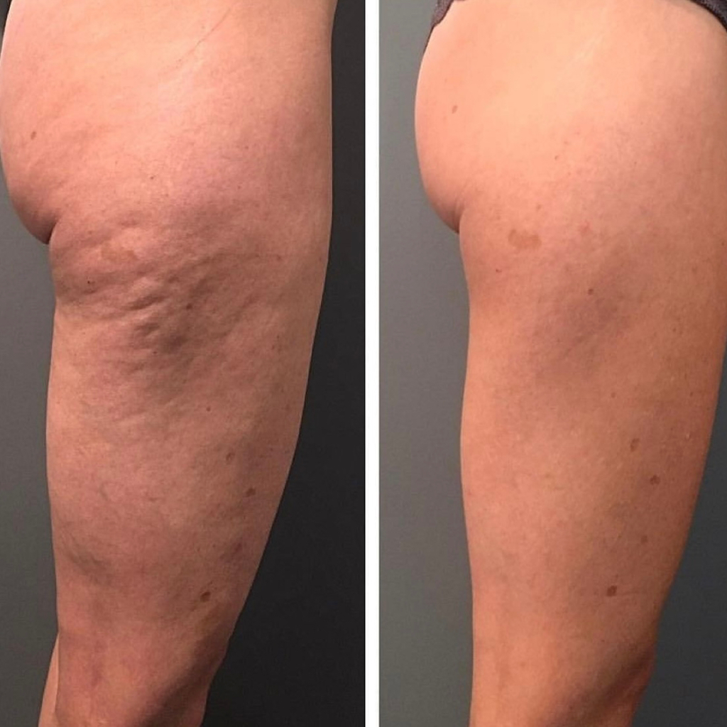 Микроигольчатый рф лифтинг зона бёдер (внутренняя поверхность)