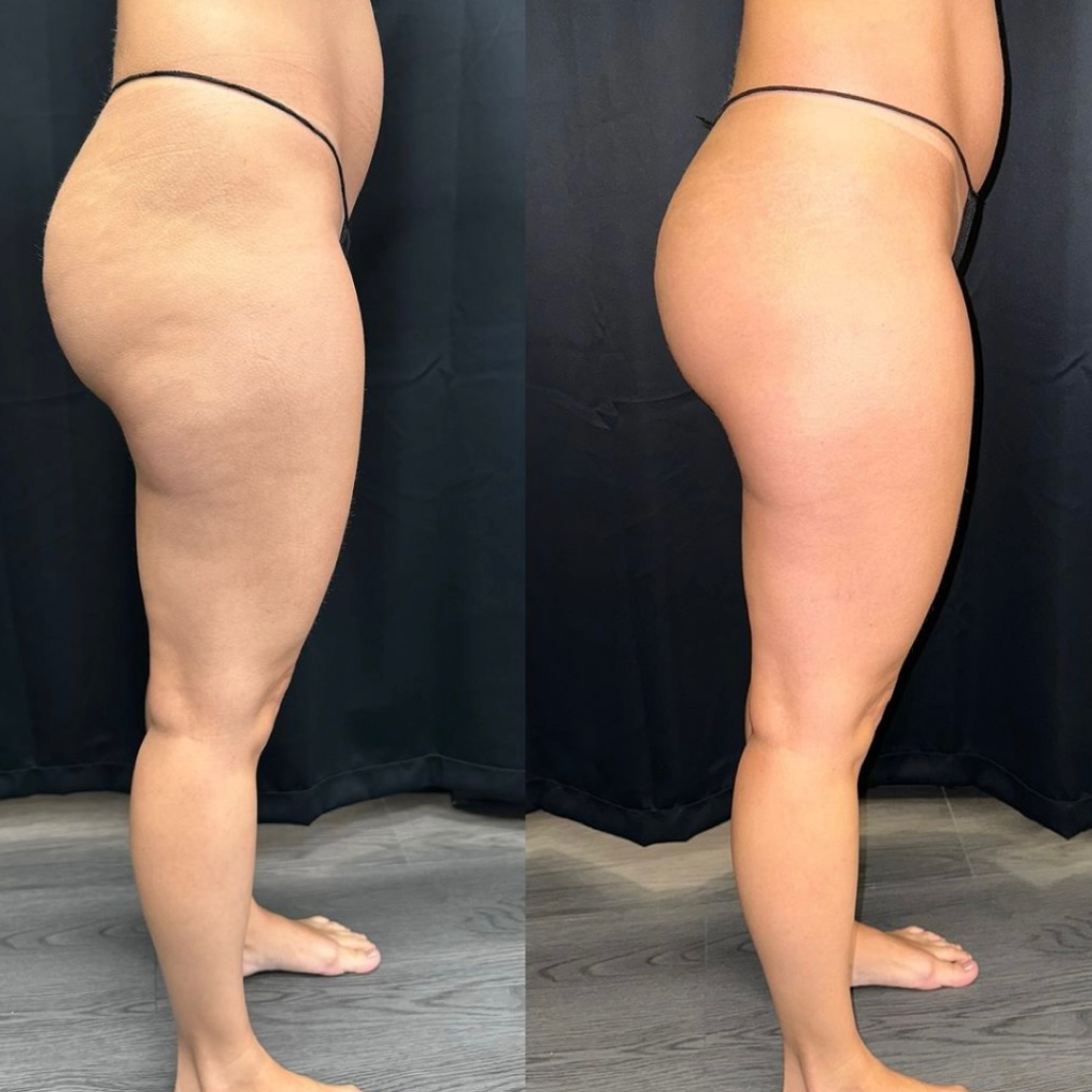 Микроигольчатый рф лифтинг зона колен