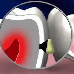 Лечение кариеса