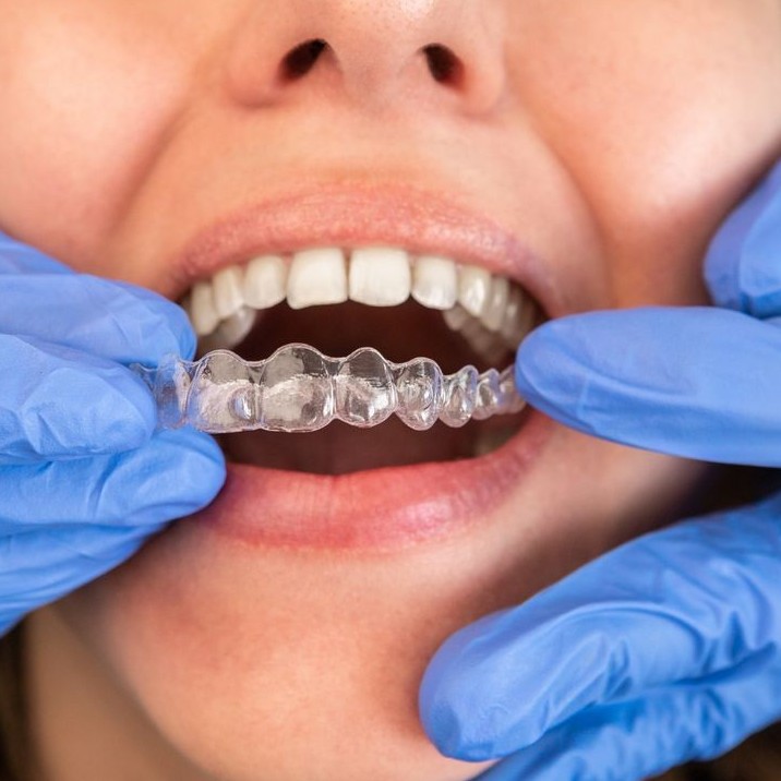 Консультация по лечению на элайнерах