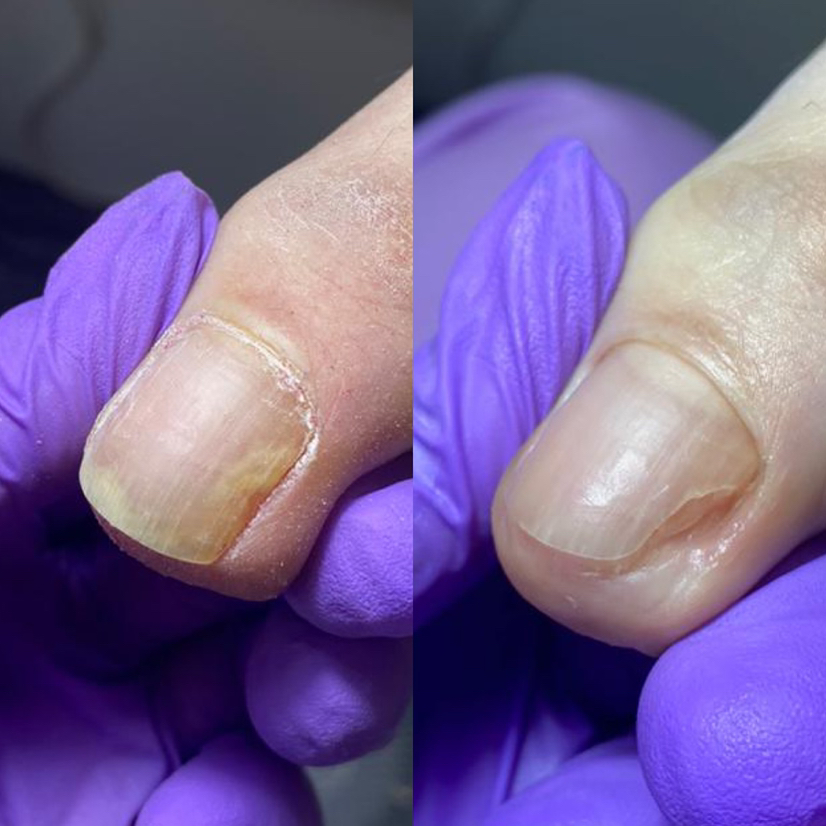 Зачистка онихолизиса 1ед