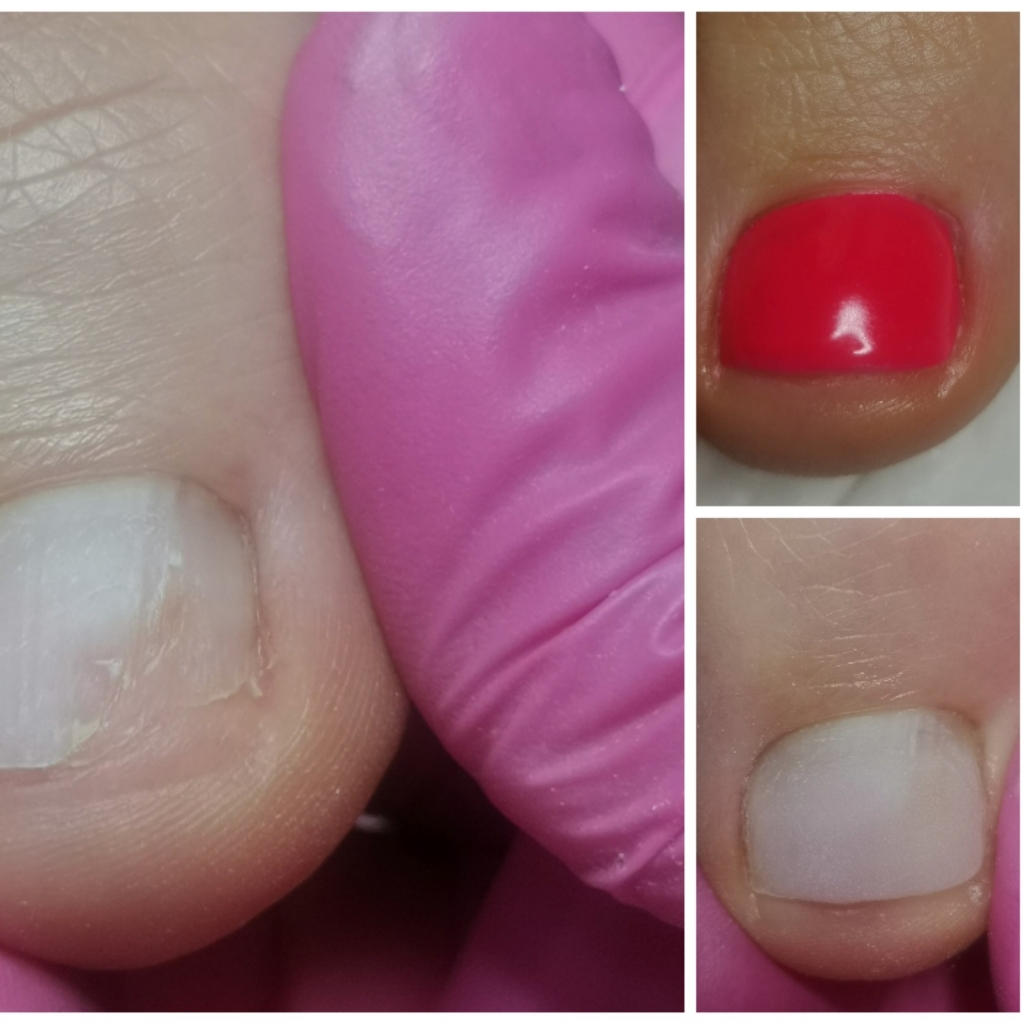 Протезирование ногтевой пластины