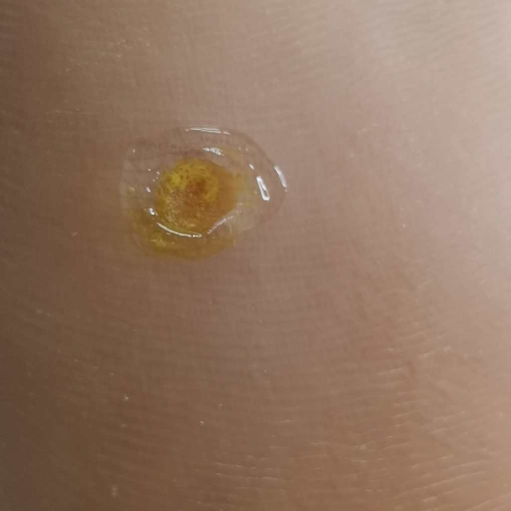 Работа с бородавками