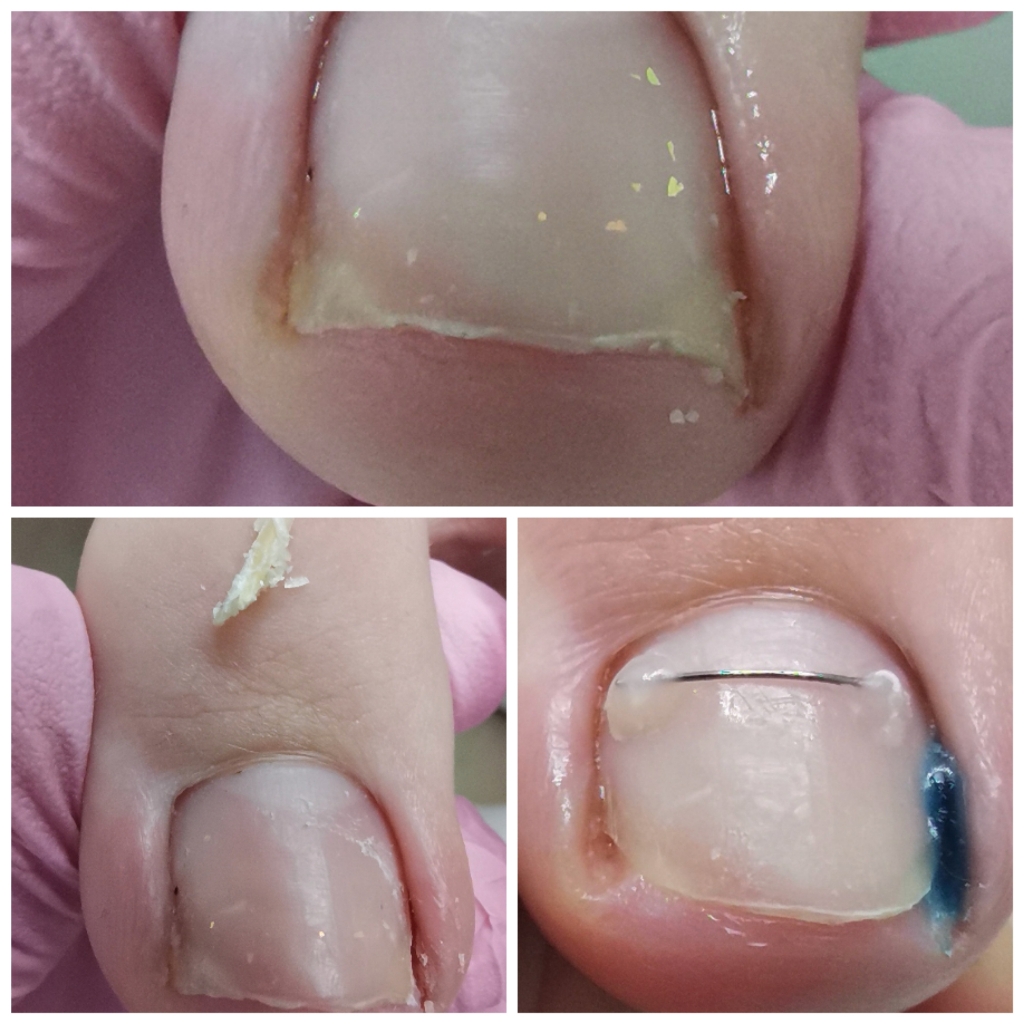 Вросший ноготь, коррекция угла