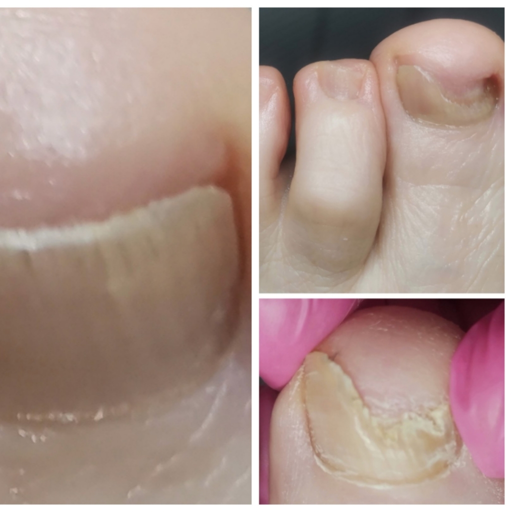 Зачистка грибка на ногтевой пластине