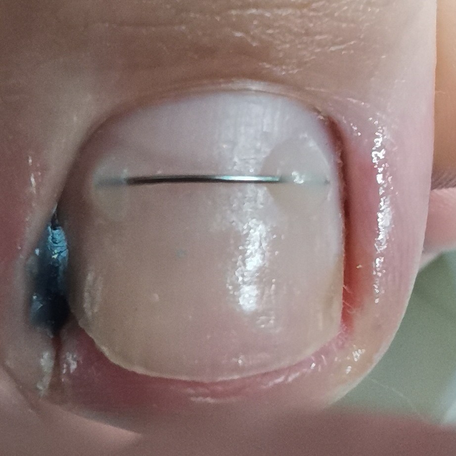 Установка коррекционной системы 