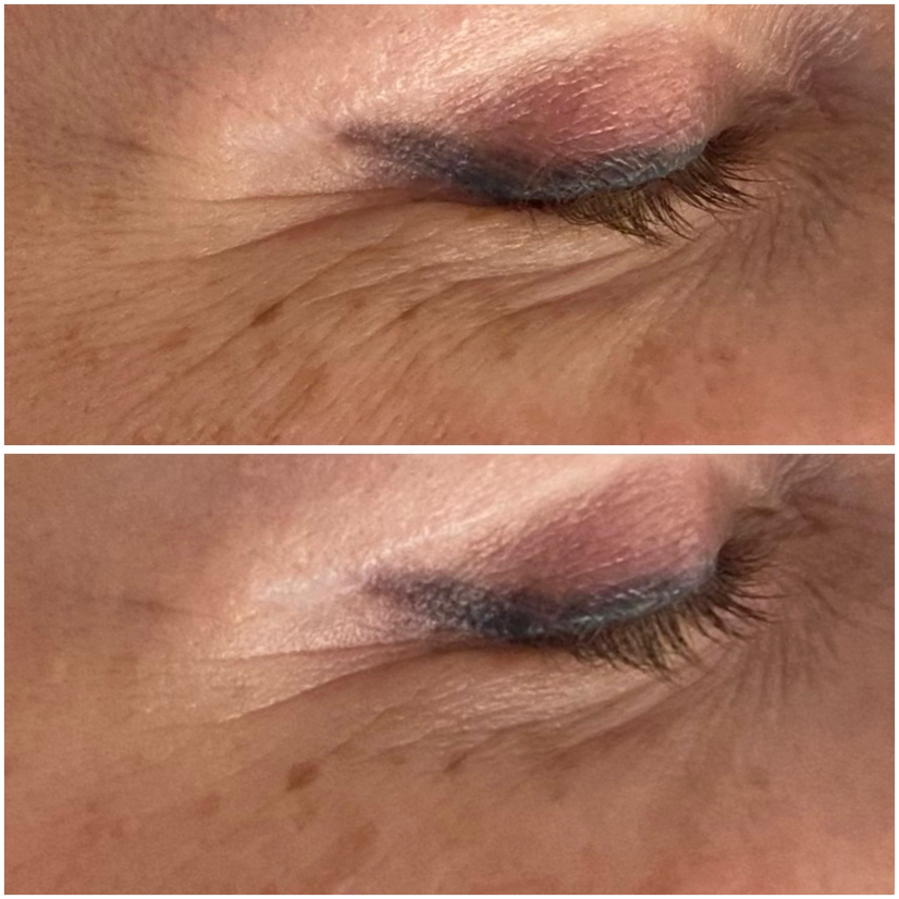 LIFTING POWER - карбокситерапия с эффектом биоревитализации.