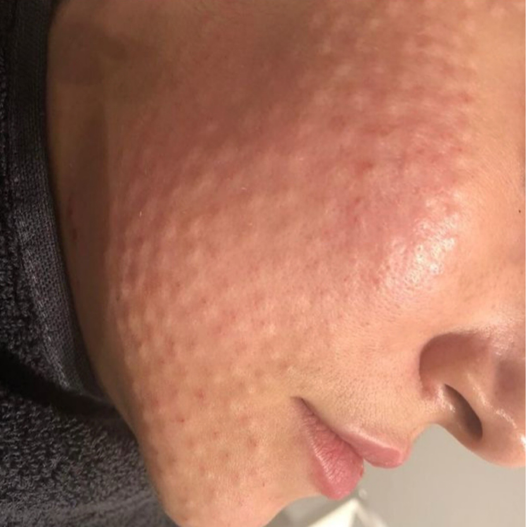 Биоревитализация