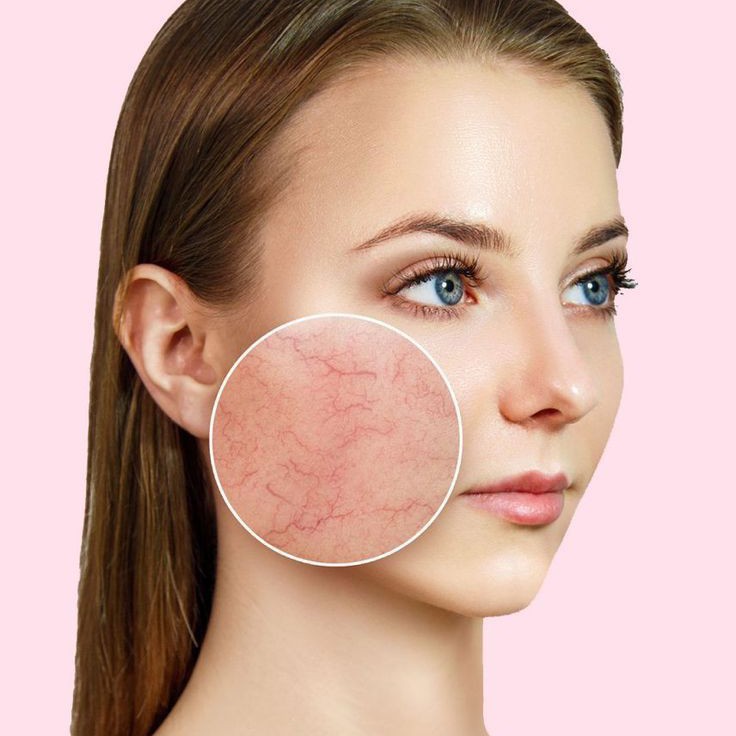 Удаление сосудистых звёздочек, купероза, сосудистых образований, корректировка сосудов.