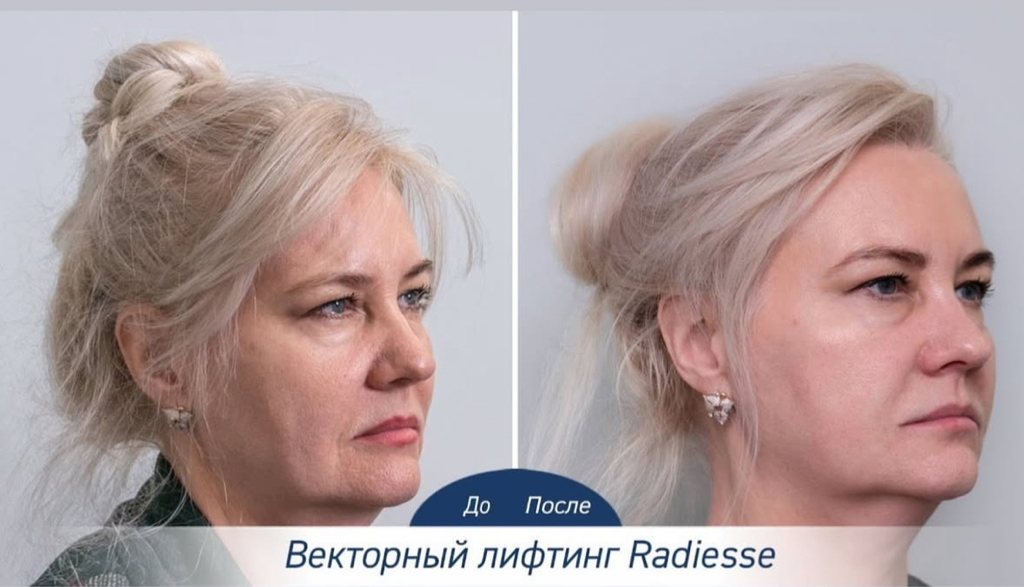 Radiesse