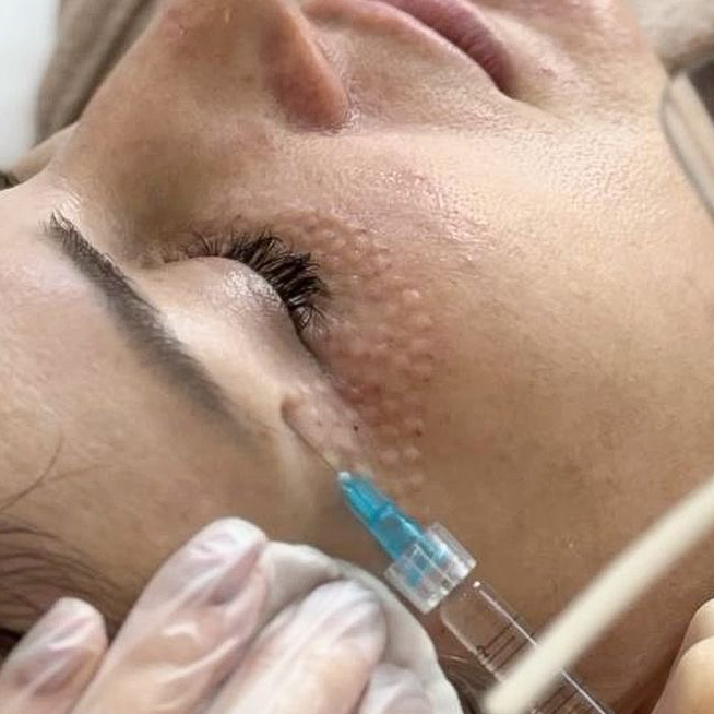 Биоревитализация области вокруг глаз