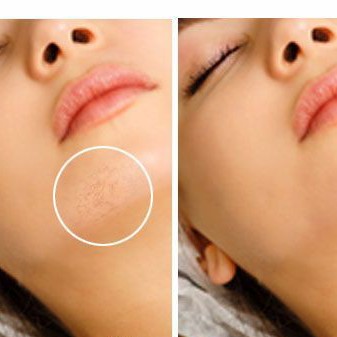 Лазерное удаление сосудистых звёздочек - подбородок