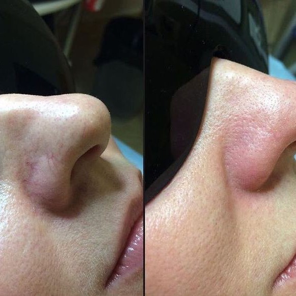 Лазерное удаление сосудистых звёздочек- нос