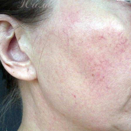 Лазерное удаление сосудистых звёздочек на лице - щёки