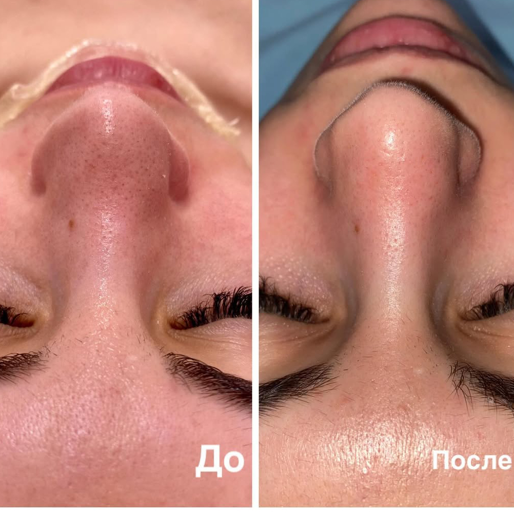 Механическая чистка + пилинг по типу кожи