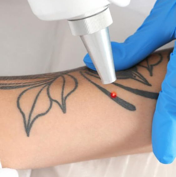 Удаление татуировок