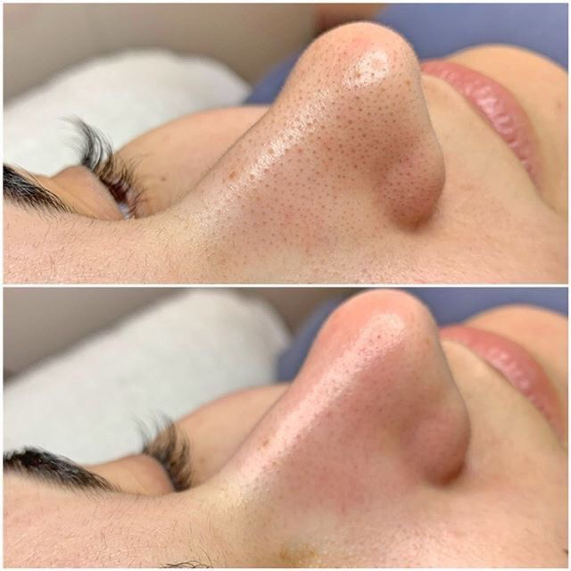 Комбинированная чистка лица+ пилинг Natinuel