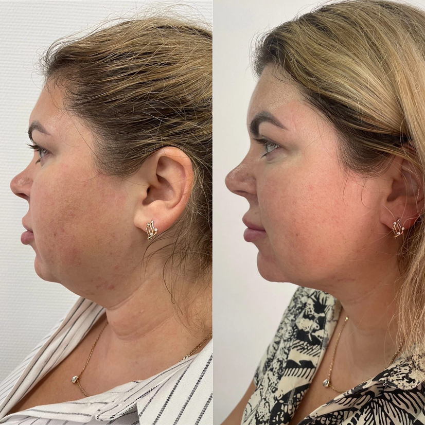 Липолитики