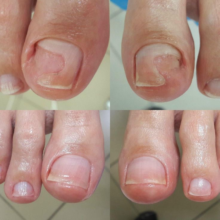 Онихолизис